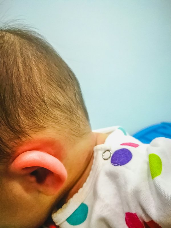 Eczéma oreille : guide complet pour soulager les irritations